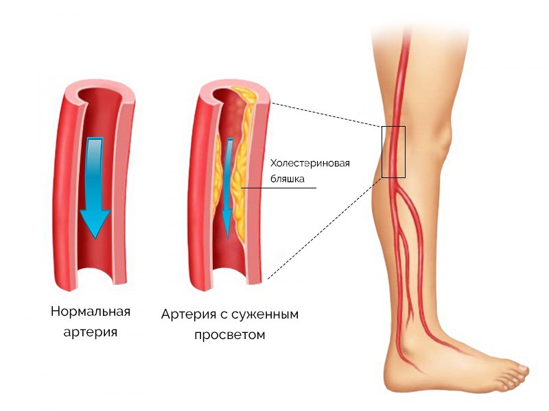 Образование холестериновых бляшек