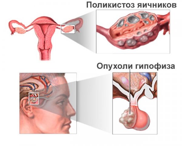 Причины олигоменореи — поликистоз яичников и оухоль гипофиза