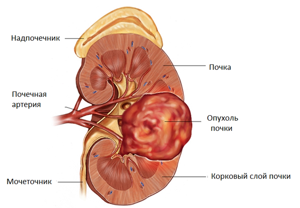 Ангиомиолипома почки