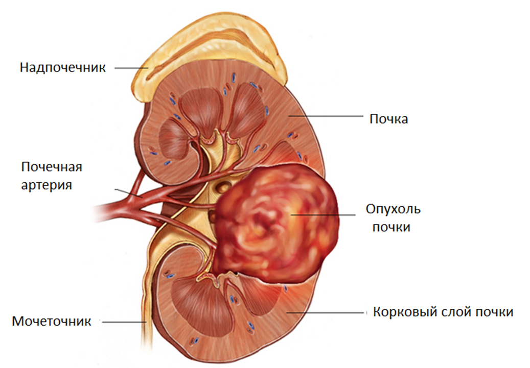 Опухоль почки