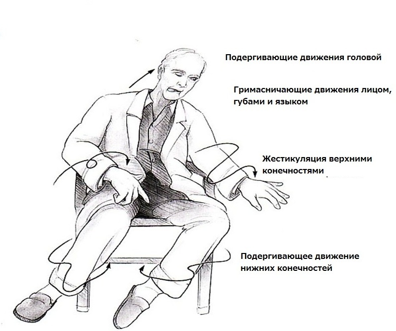 Проявления хореи