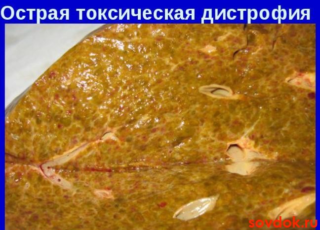 острая токсическая дистрофия