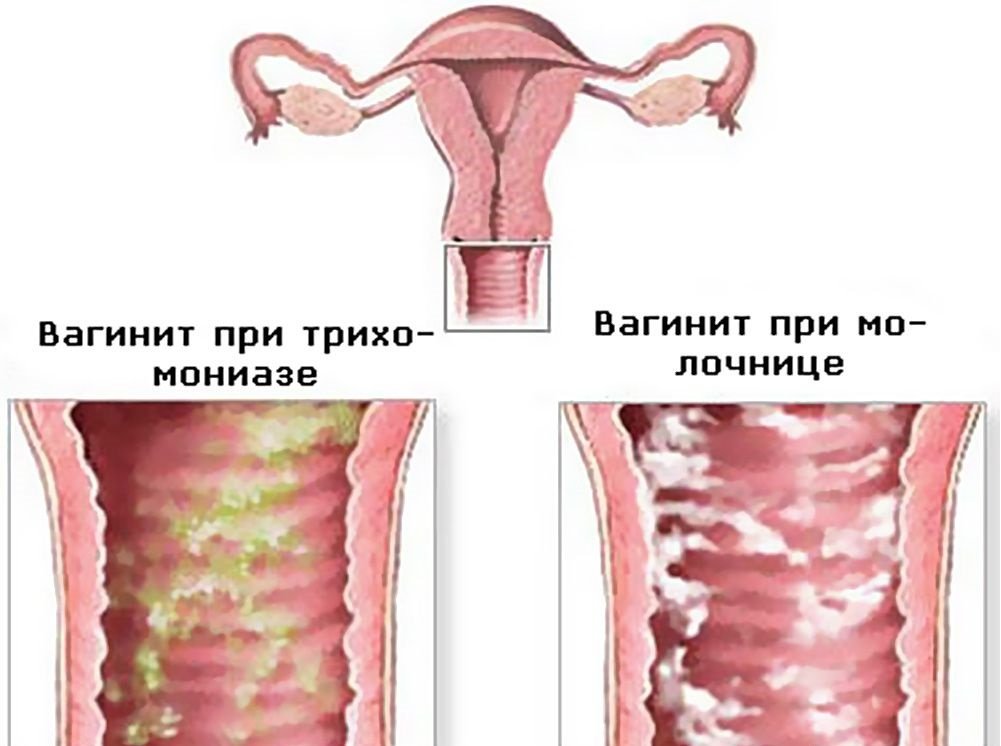 острый вагинит