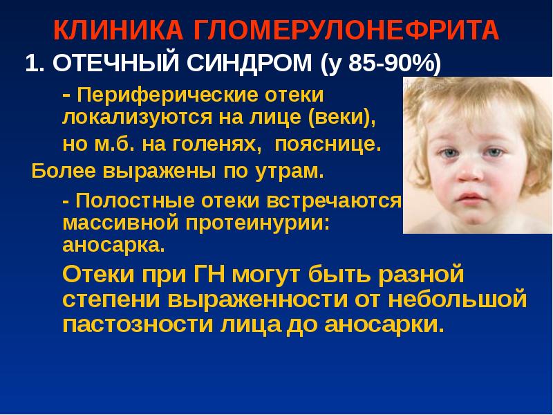 Отёки при гломерулонефрите