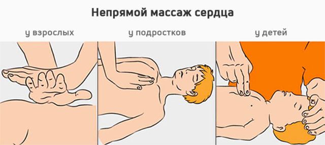 Отличие в осуществлении непрямого массажа сердца у разных возрастных категорий