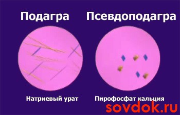 отличия подагры от псевдоподагры