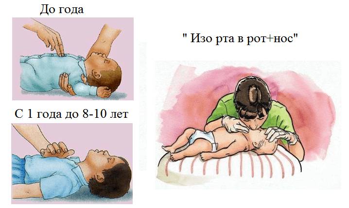 Отличия техники выполнения ИМС и ИВЛ у грудных и маленьких детей от взрослых
