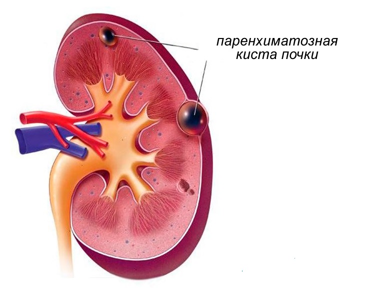 Паренхиматозная опухоль почки
