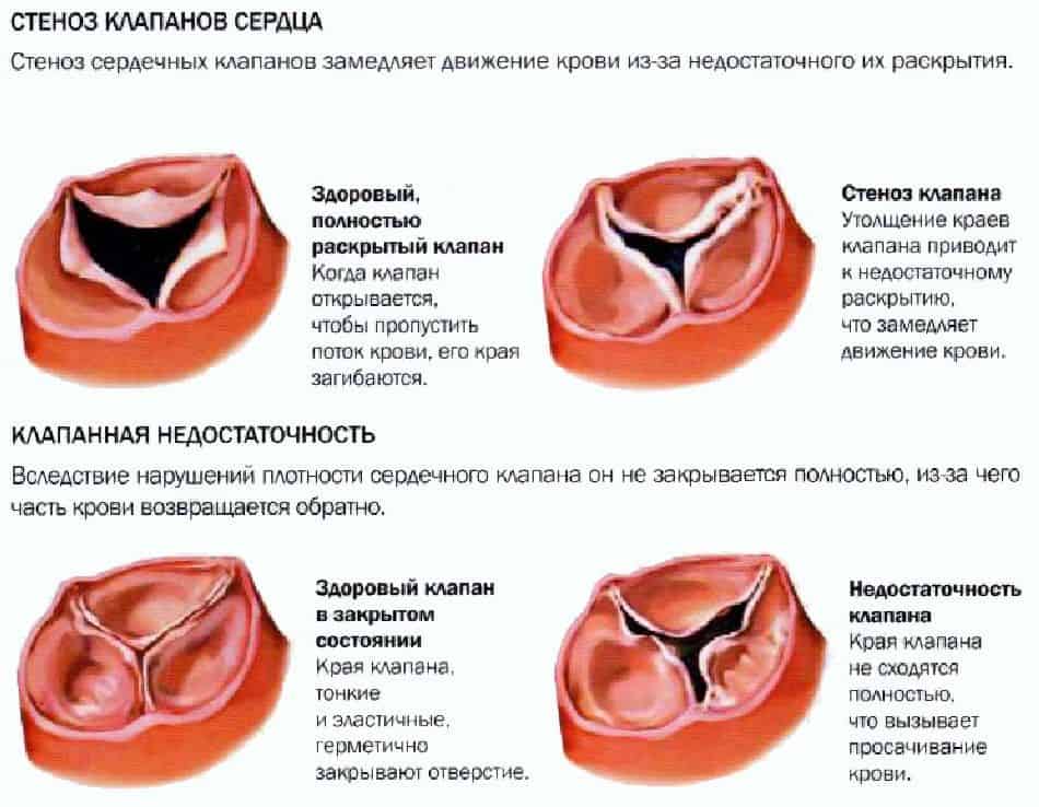 Патологии сердечных клапанов