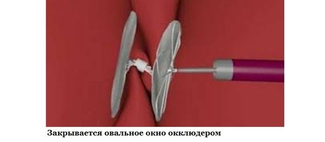 Перекрытие окна в межсердечной перегородки эндоваскурярными методиками