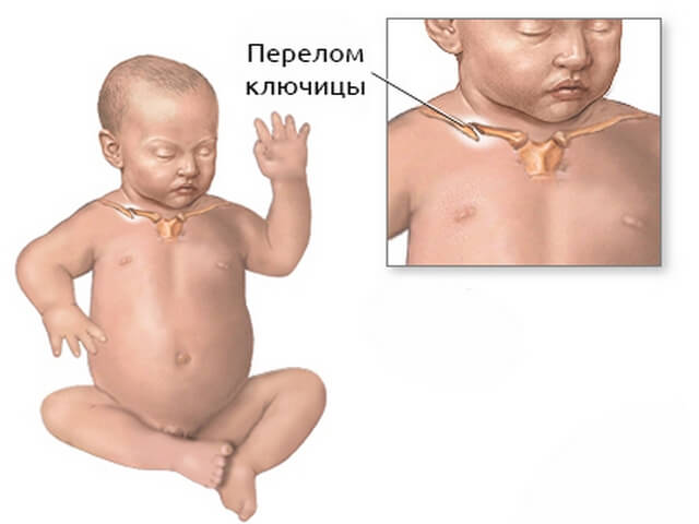 Перелом ключицы у ребёнка