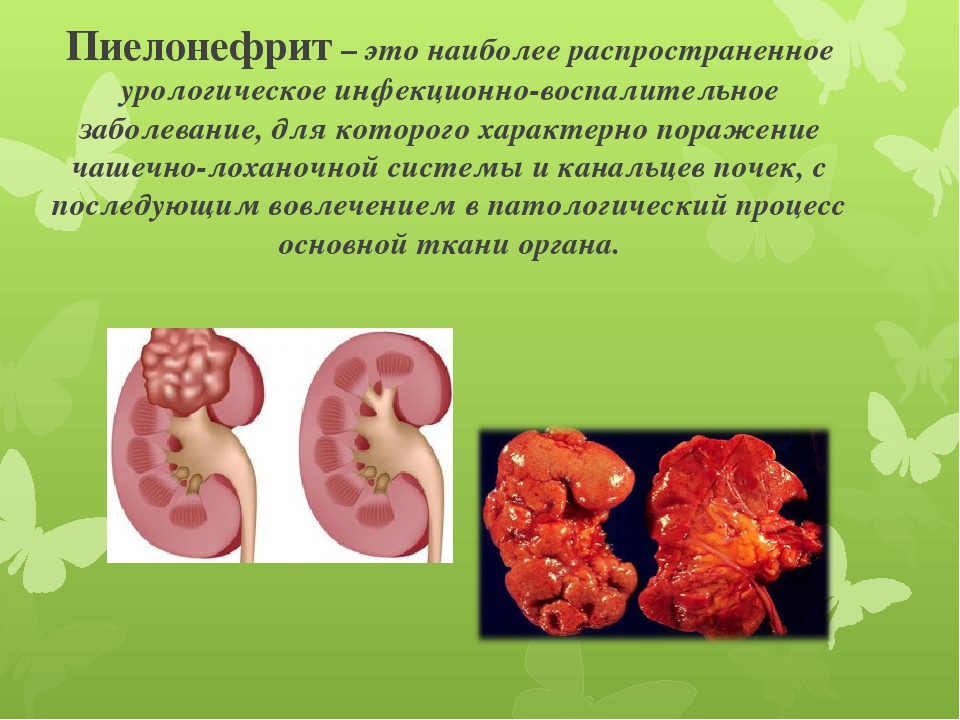 Пиелонефрит