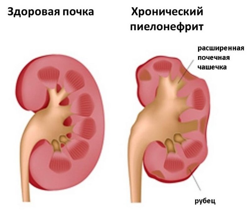 Изображение здоровой почки и поражённой хроническим пиелонефритом