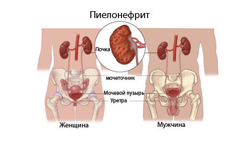 Пиелонефрит