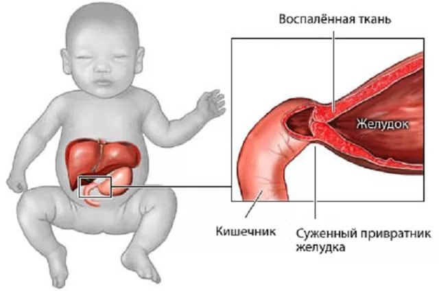 Пилороспазм у новорожденных