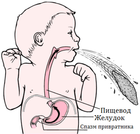 Пилороспазм