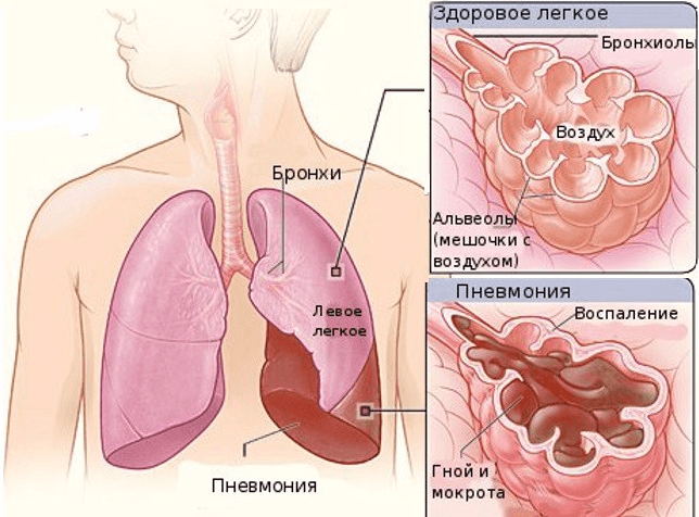 Пневмония