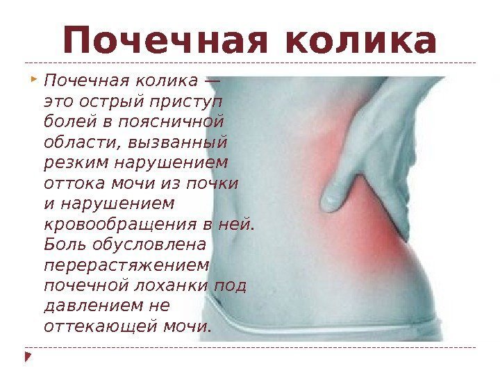 Почечная колика