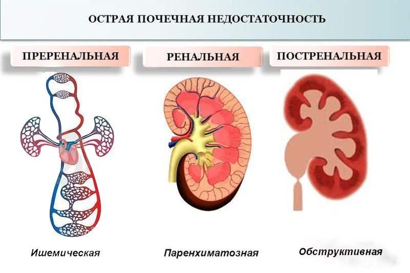 Почечная недостаточность