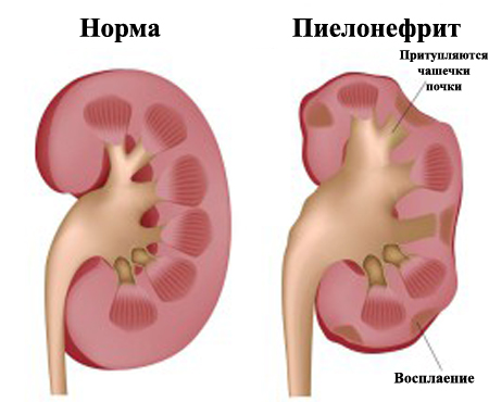 Почка нормальная и поражённая острым пиелонефритом