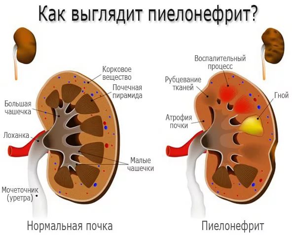 Почки: здоровая и поражённая пиелонефритом