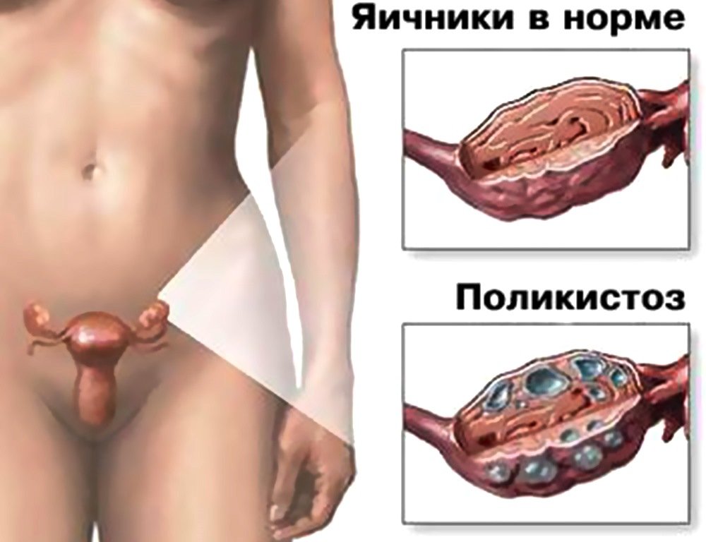 Поликистоз яичников