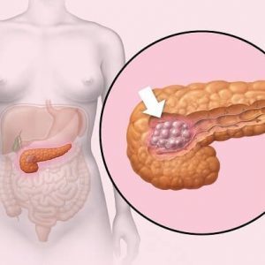 Что такое полипы в поджелудочной и как их лечить
