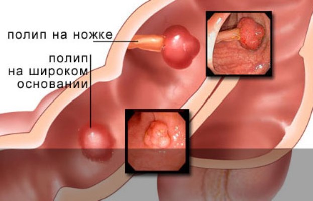 Полипы в желудке