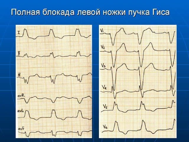 Полная блокада левой ножки