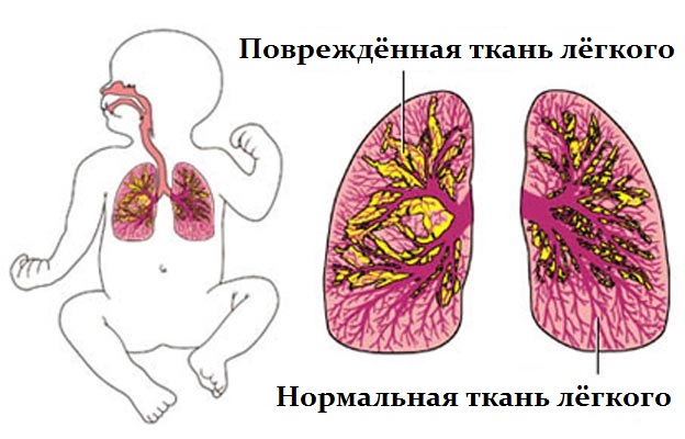 Поражения долей лёгкого при воспалении