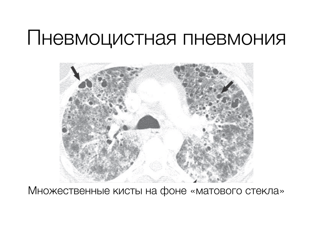Поражения лёгких при пневмоцитозе