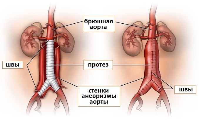После операции кровоток в месте постановки протеза полностью возобновляется.