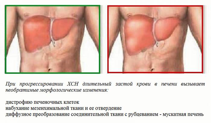 Последствия увеличения печени при хронической сердечно-сосудистой недостаточности