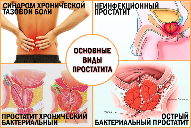 Виды простатита