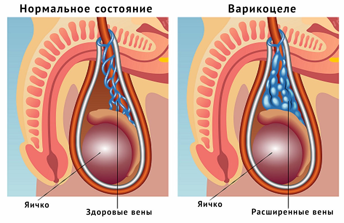 Нормальное состояние и варикоцеле