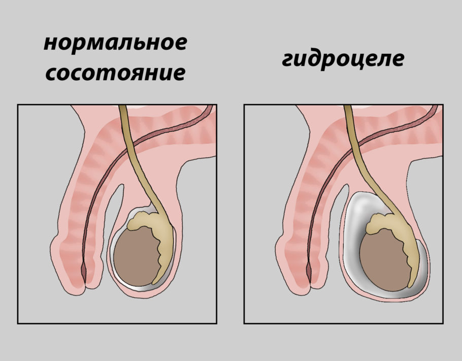 Гидроцеле
