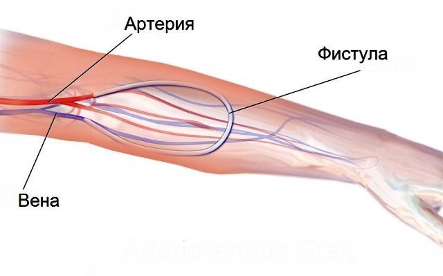 Артериовенозная фистула