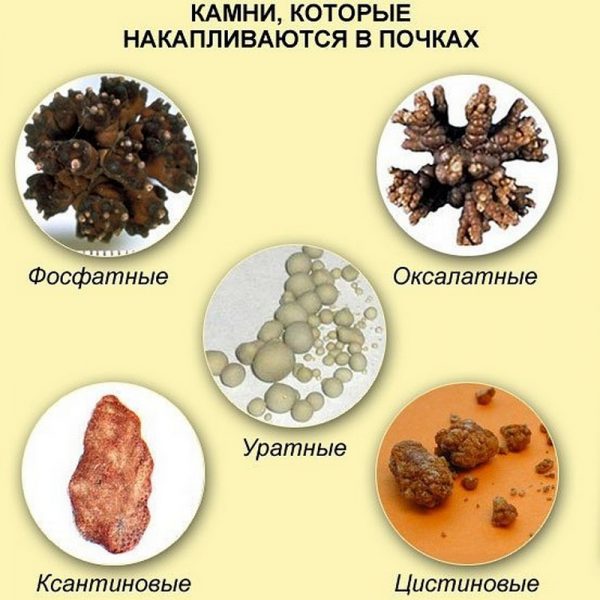 Виды почечных камней