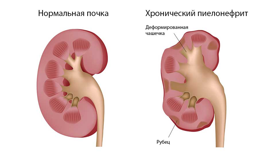 Хронический пиелонефрит