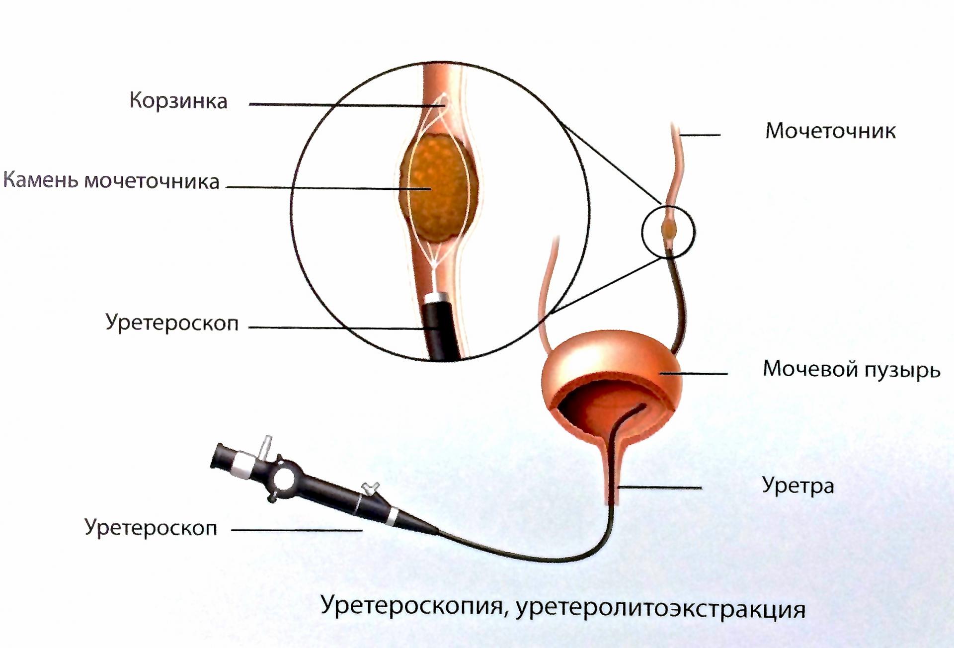 Эндоскопическая литотрипсия