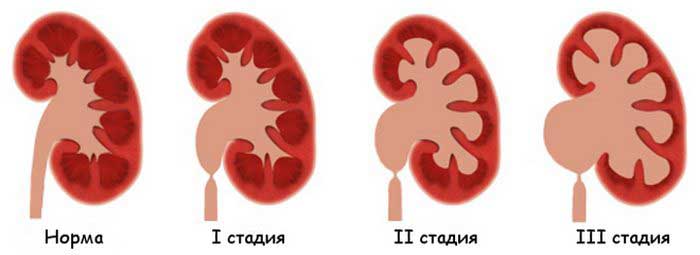 Стадии развития гидронефроза