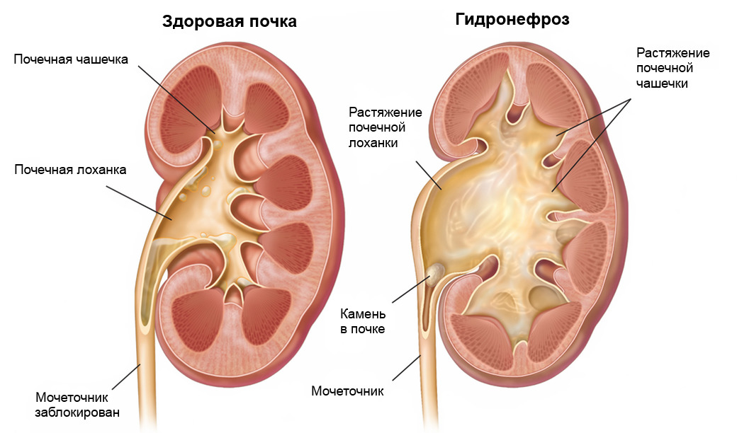 Мочекаменная болезнь и гидронефроз