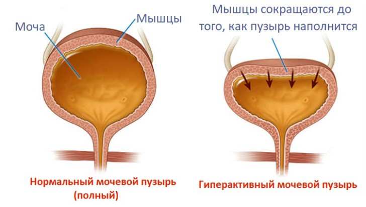 Гиперактивный мочевой пузырь