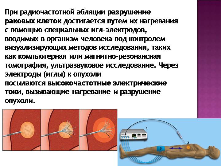 Радиочастотная абляция