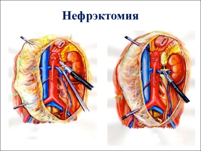 Нефрэктомия