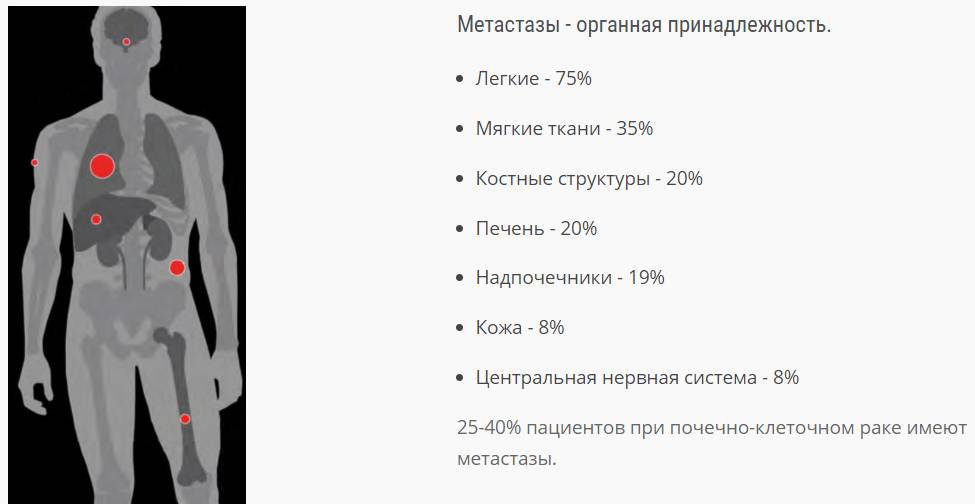 Частота метастазов в различных органах