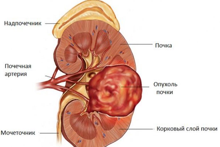 Рак почки