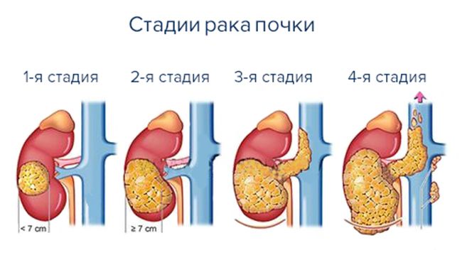 Стадии рака почек