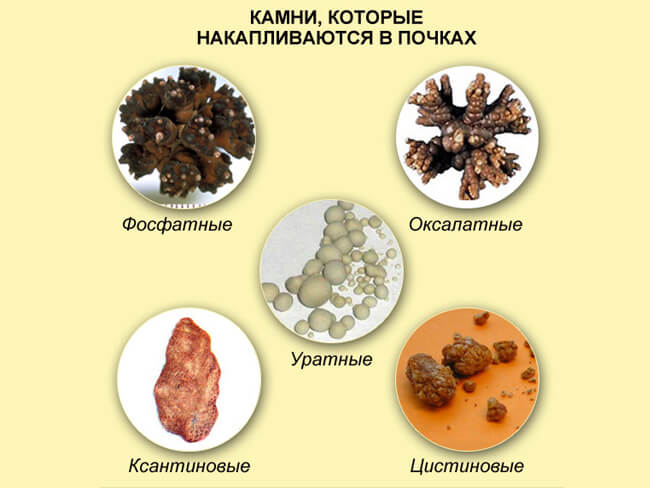 Виды камней в почках
