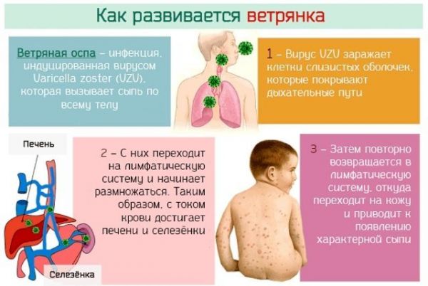 Процесс развития ветрянки